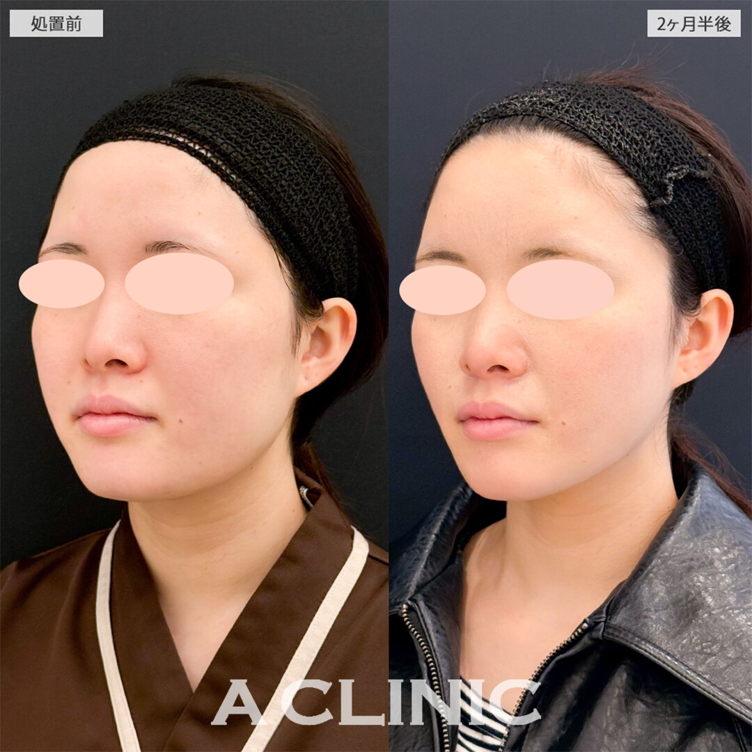1day小顔脂肪吸引と小顔エラボトックスで一回り顔が小さくなりました！こちら処置前と2ヶ月半後の症例です(20代女性)