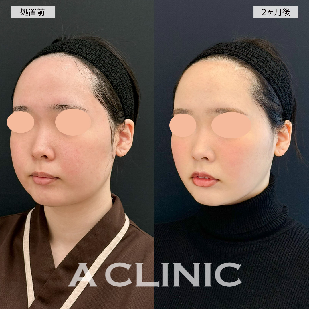 1day小顔脂肪吸引でお顔が一回り以上小さくなり自信が持てるようになりました！こちら処置前と2ヶ月後の症例です(20代女性)