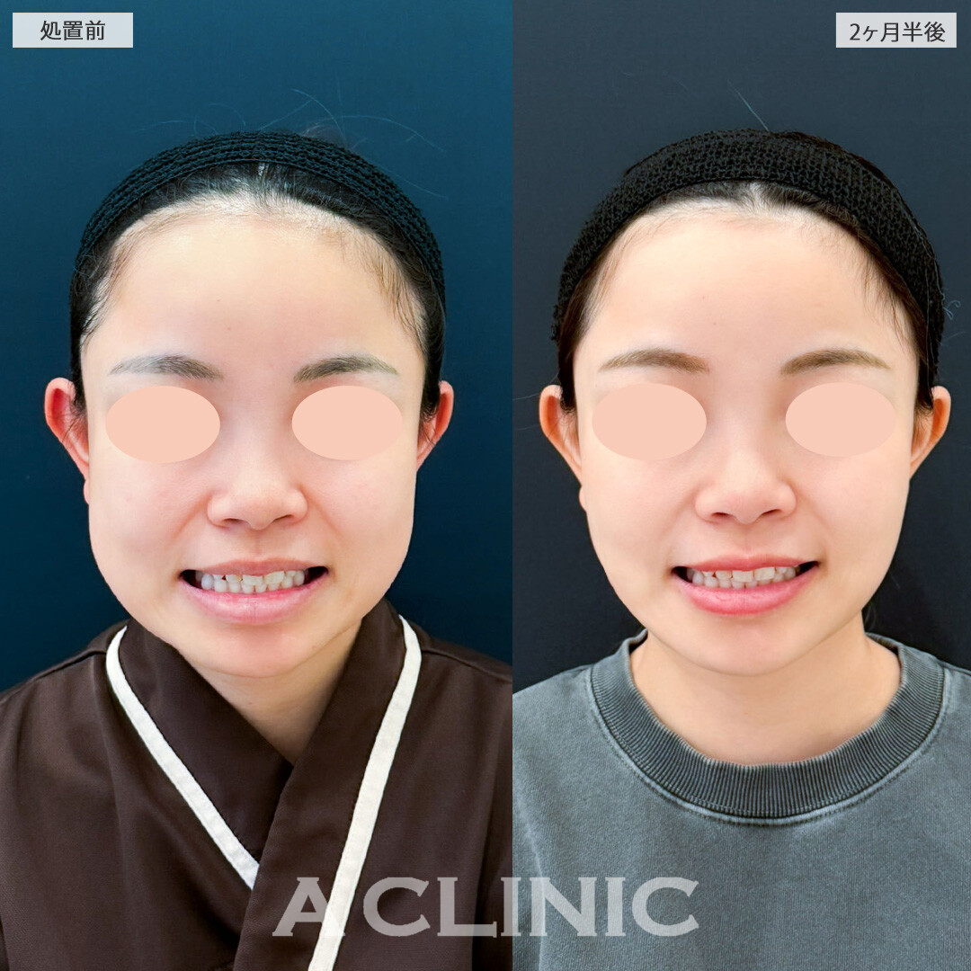 1day小顔脂肪吸引とバッカルファット除去術で下膨れがスッキリしました！こちら処置前と2ヶ月半後の症例です(20代女性)