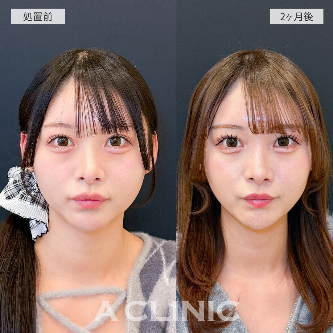 ハッキリしたフェイスラインになり垢抜けました！1day小顔脂肪吸引の処置前と2ヶ月後の症例です(20代女性)