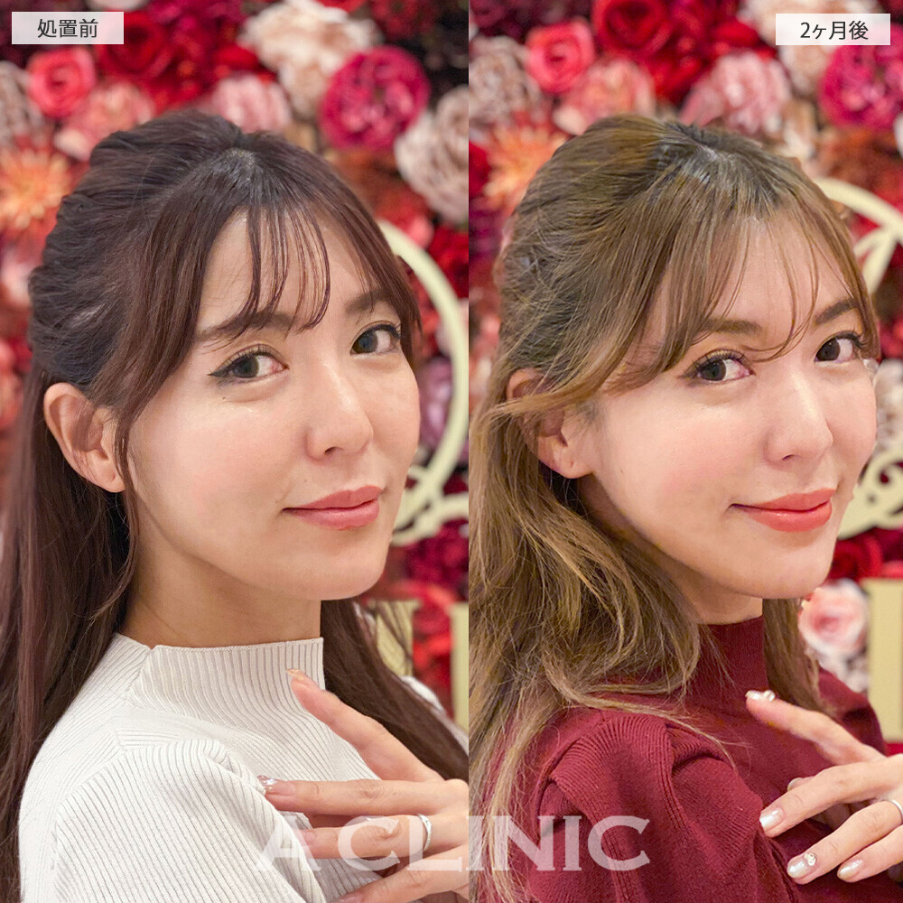 1day小顔脂肪吸引で左右差のない均等な輪郭に！こちら処置前と2ヶ月後の症例です(30代女性)