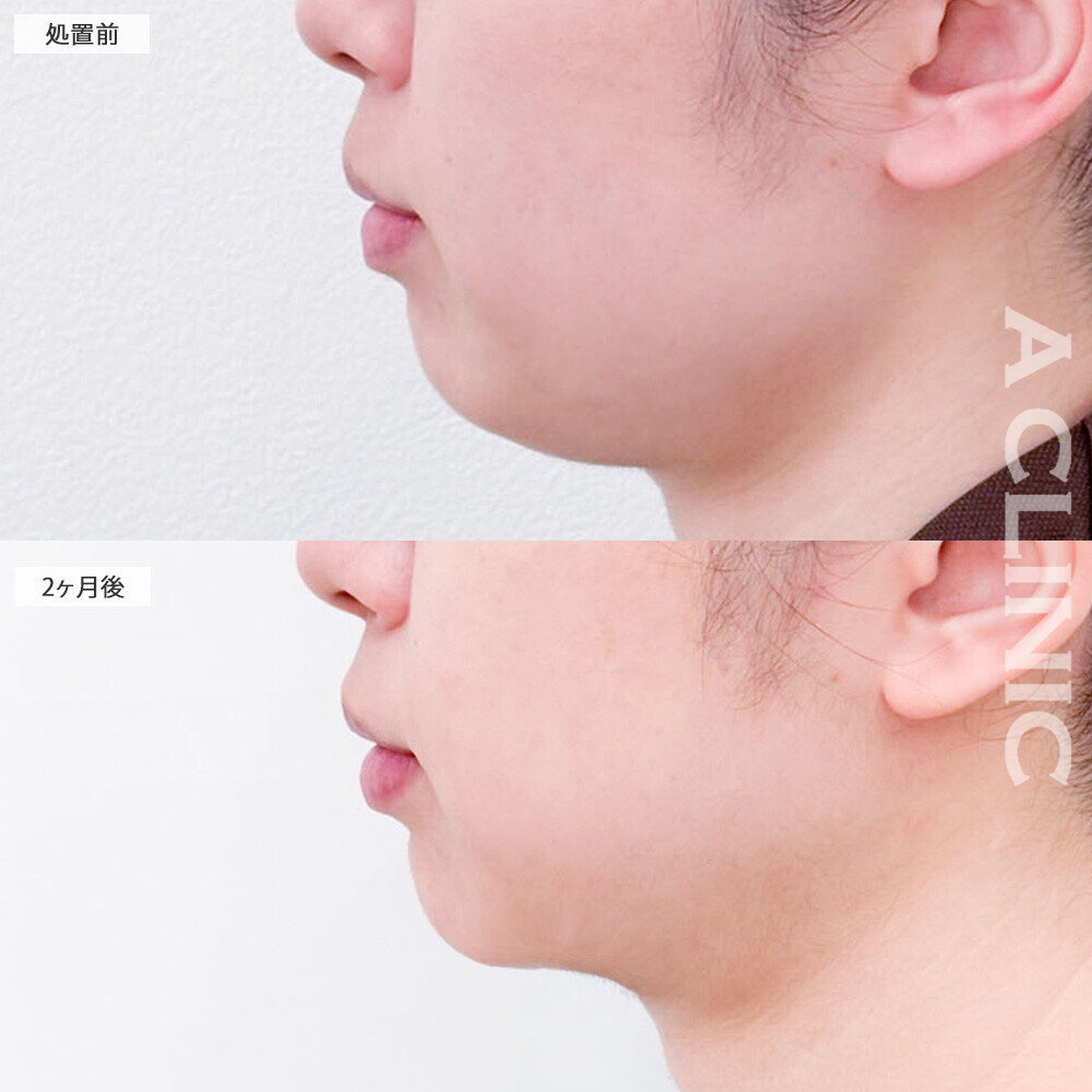1day小顔脂肪吸引であご下の脂肪が減って二重アゴにならなくなりました！処置前から2ヶ月後の症例です(30代女性)