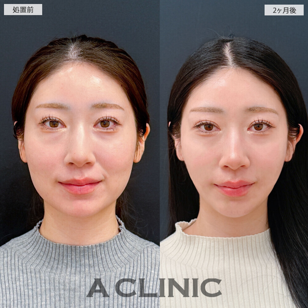 1day小顔脂肪吸引と小顔エラボトックスで見違える程スッキリとした輪郭に！こちら処置前と2ヶ月後の症例です(20代女性)