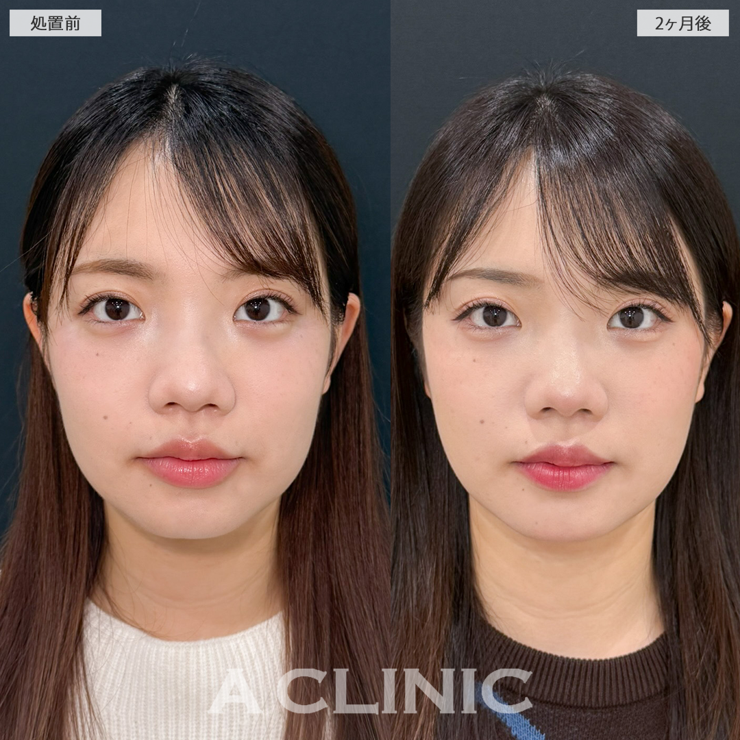 1day小顔脂肪吸引でアゴ下のお肉がスッキリしました！処置前と2ヶ月後の症例です(20代女性)