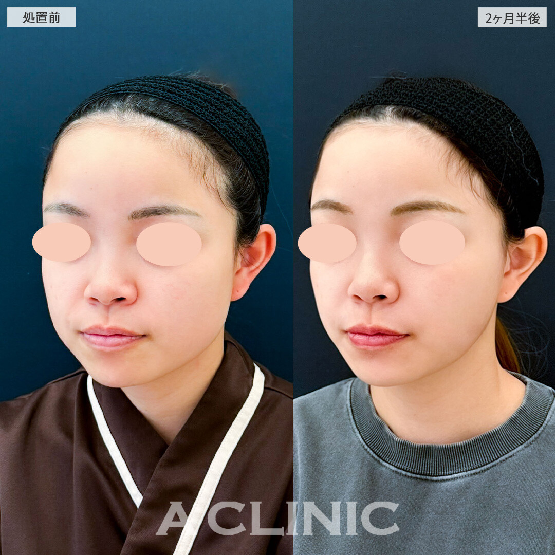 1day小顔脂肪吸引とバッカルファット除去術で下膨れがスッキリしました！こちら処置前と2ヶ月半後の症例です(20代女性)