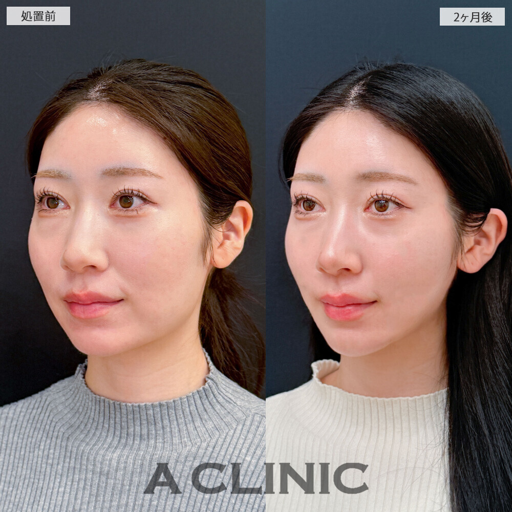 1day小顔脂肪吸引と小顔エラボトックスで見違える程スッキリとした輪郭に！こちら処置前と2ヶ月後の症例です(20代女性)