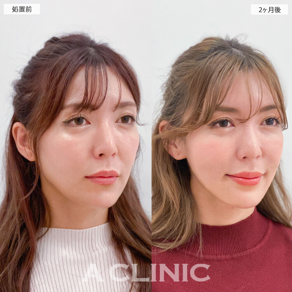 1day小顔脂肪吸引で左右差のない均等な輪郭に！こちら処置前と2ヶ月後の症例です(30代女性)