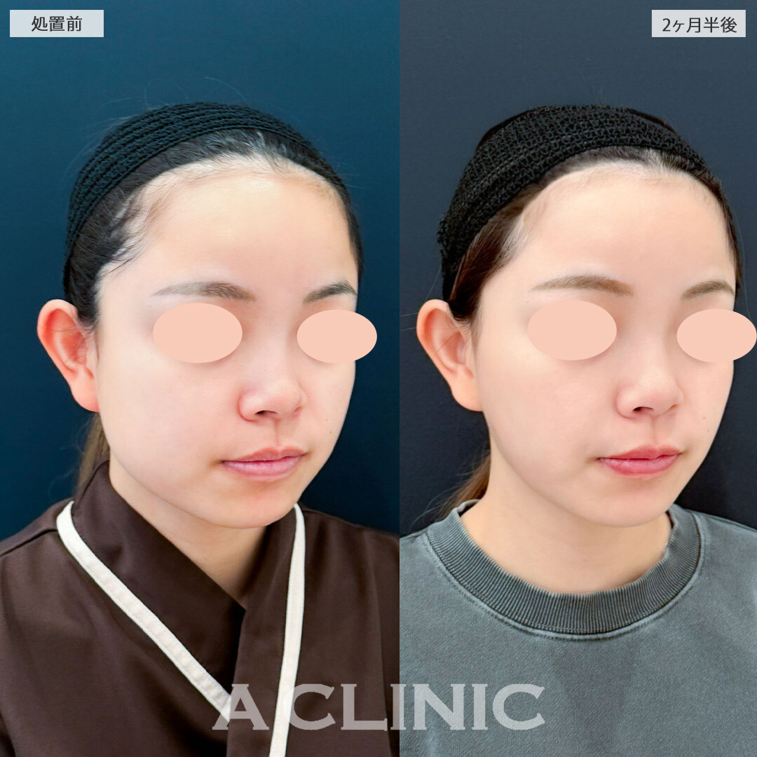 1day小顔脂肪吸引とバッカルファット除去術で下膨れがスッキリしました！こちら処置前と2ヶ月半後の症例です(20代女性)