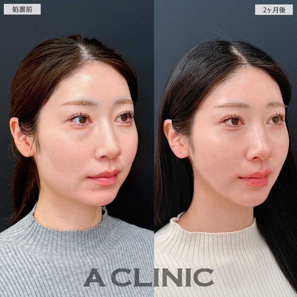 1day小顔脂肪吸引と小顔エラボトックスで見違える程スッキリとした輪郭に！こちら処置前と2ヶ月後の症例です(20代女性)