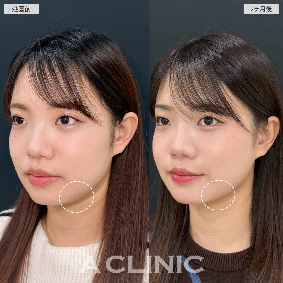 1day小顔脂肪吸引でアゴ下のお肉がスッキリしました！処置前と2ヶ月後の症例です(20代女性)