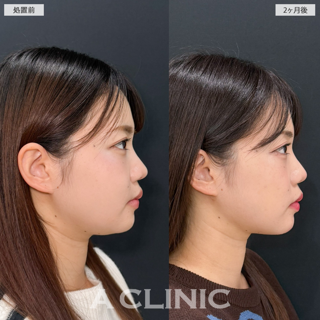 1day小顔脂肪吸引でアゴ下のお肉がスッキリしました！処置前と2ヶ月後の症例です(20代女性)