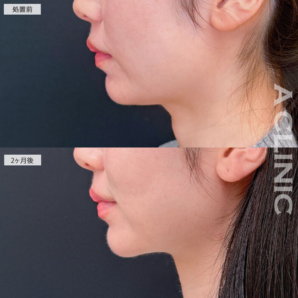 1day小顔脂肪吸引と小顔エラボトックスで見違える程スッキリとした輪郭に！こちら処置前と2ヶ月後の症例です(20代女性)