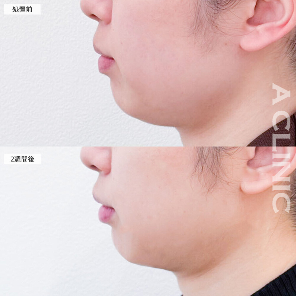 1day小顔脂肪吸引であご下の脂肪が減って二重アゴにならなくなりました！処置前から2ヶ月後の症例です(30代女性)