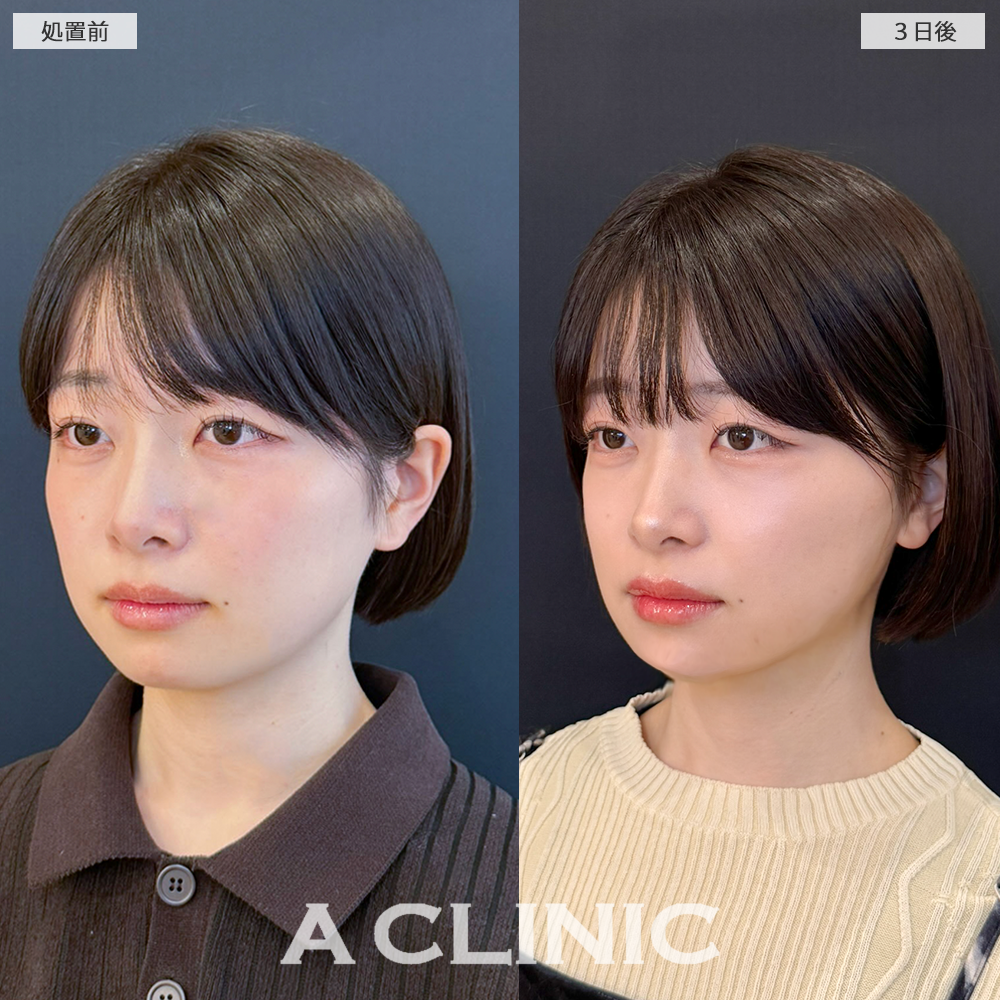 1day小顔脂肪吸引でEラインもスッキリしました！こちら処置前と3日後の症例です(20代女性)