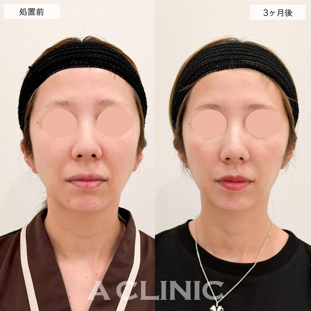 1day小顔脂肪吸引で悩みだった口横のもたつきがスッキリ!こちら処置前と3ヶ月後の症例です(30代女性)