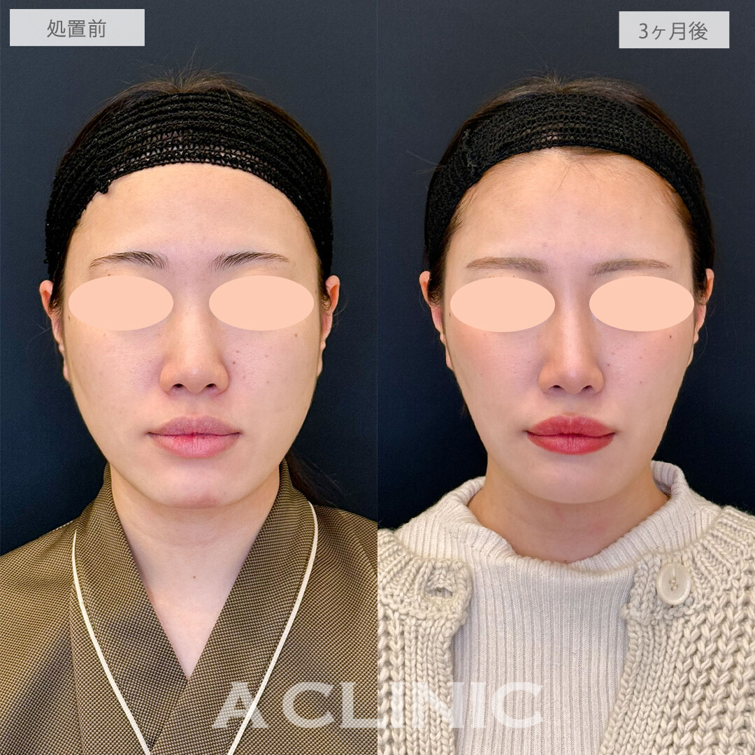 1day小顔脂肪吸引と小顔エラボトックスでお顔がひと回り以上小さくなりました！こちら処置前と3ヶ月後の症例です(20代女性)