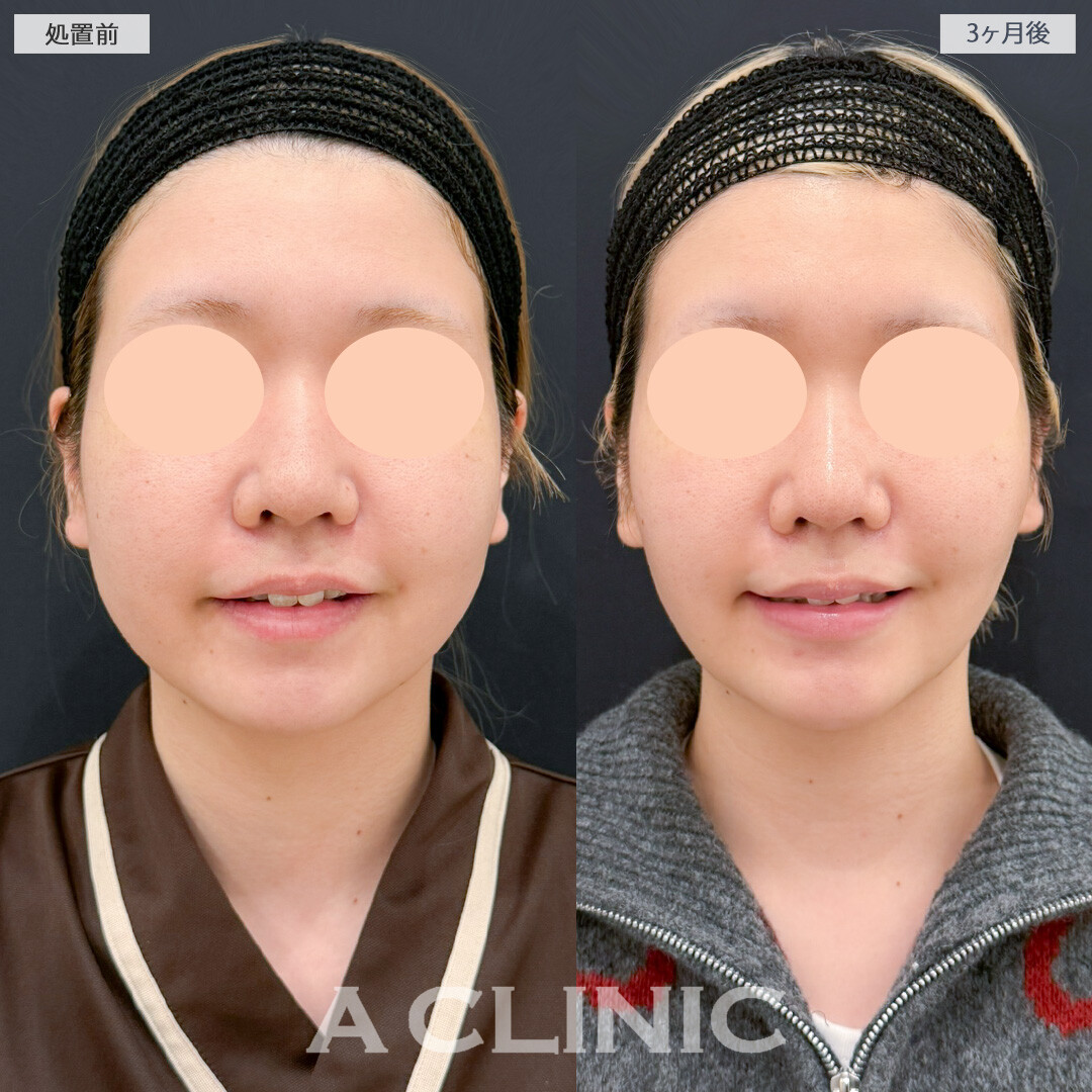 1day小顔脂肪吸引とバッカルファット除去術とあごへのヒアルロン酸注入で下顔面の丸みを解消して輪郭を修正！処置前と3ヶ月後の症例です(20代女性)