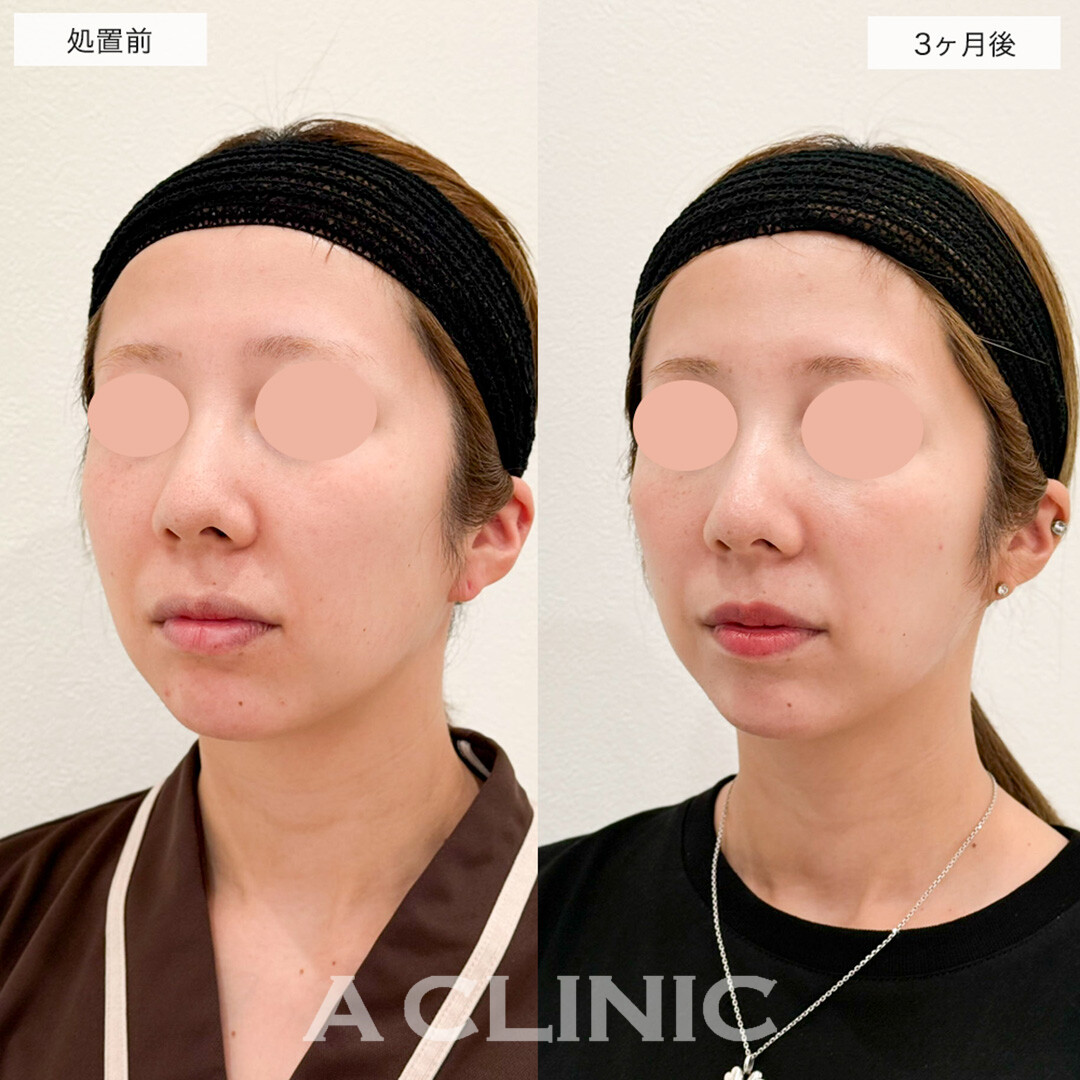 1day小顔脂肪吸引で悩みだった口横のもたつきがスッキリ!こちら処置前と3ヶ月後の症例です(30代女性)