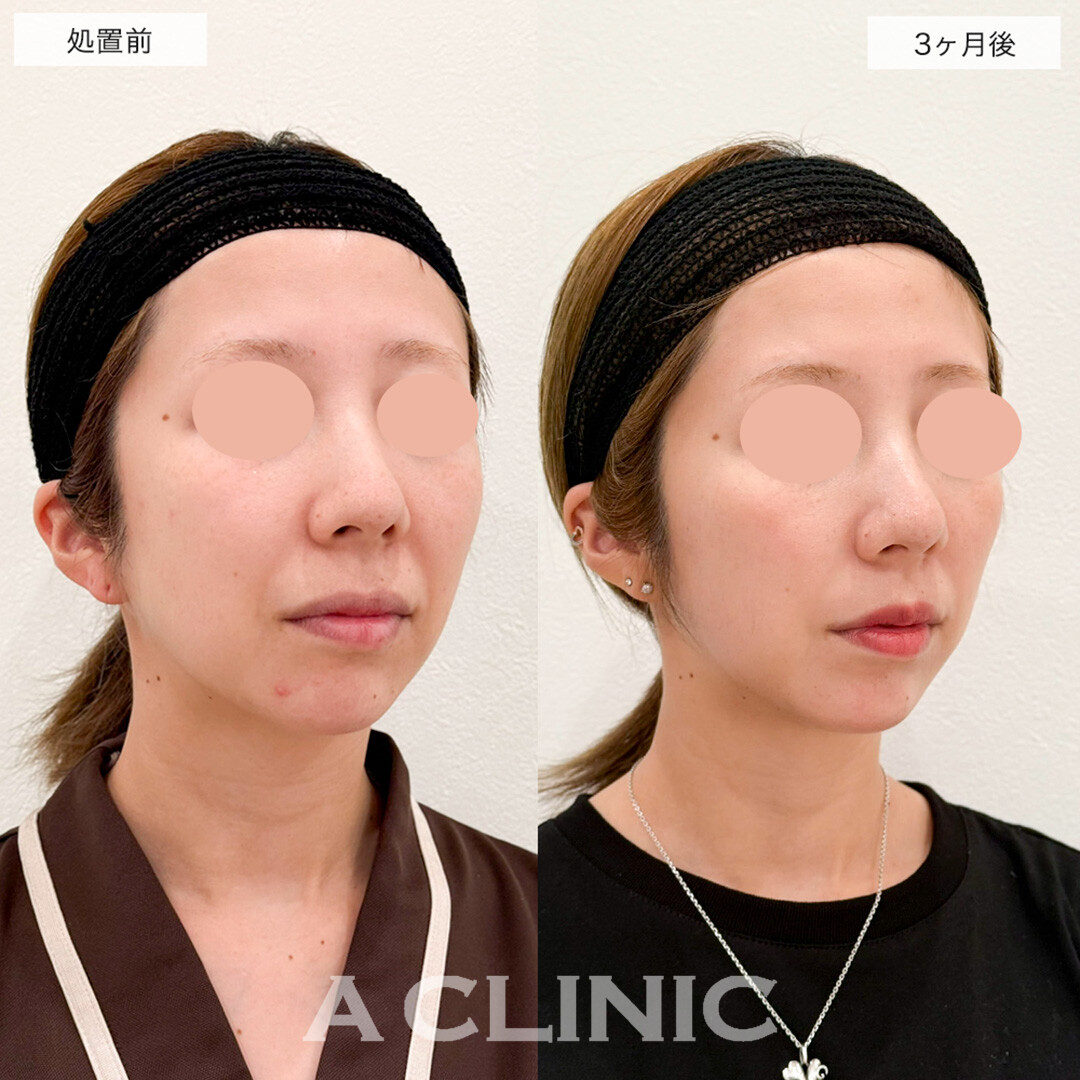 1day小顔脂肪吸引で悩みだった口横のもたつきがスッキリ!こちら処置前と3ヶ月後の症例です(30代女性)