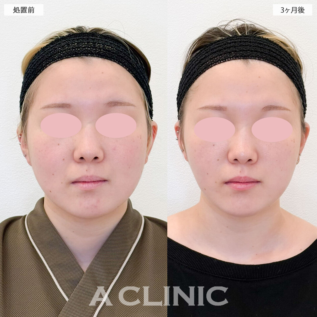 1day小顔脂肪吸引と小顔エラボトックスで丸顔とほうれい線の悩みを解消！こちら処置前と3ヶ月後の症例です(20代女性)