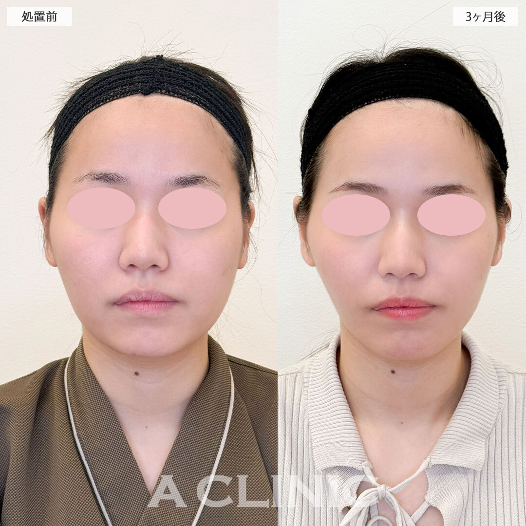 1day小顔脂肪吸引と小顔エラボトックスでお顔が一回り小さく！こちら処置前と処置3ヶ月後の症例です(20代女性)