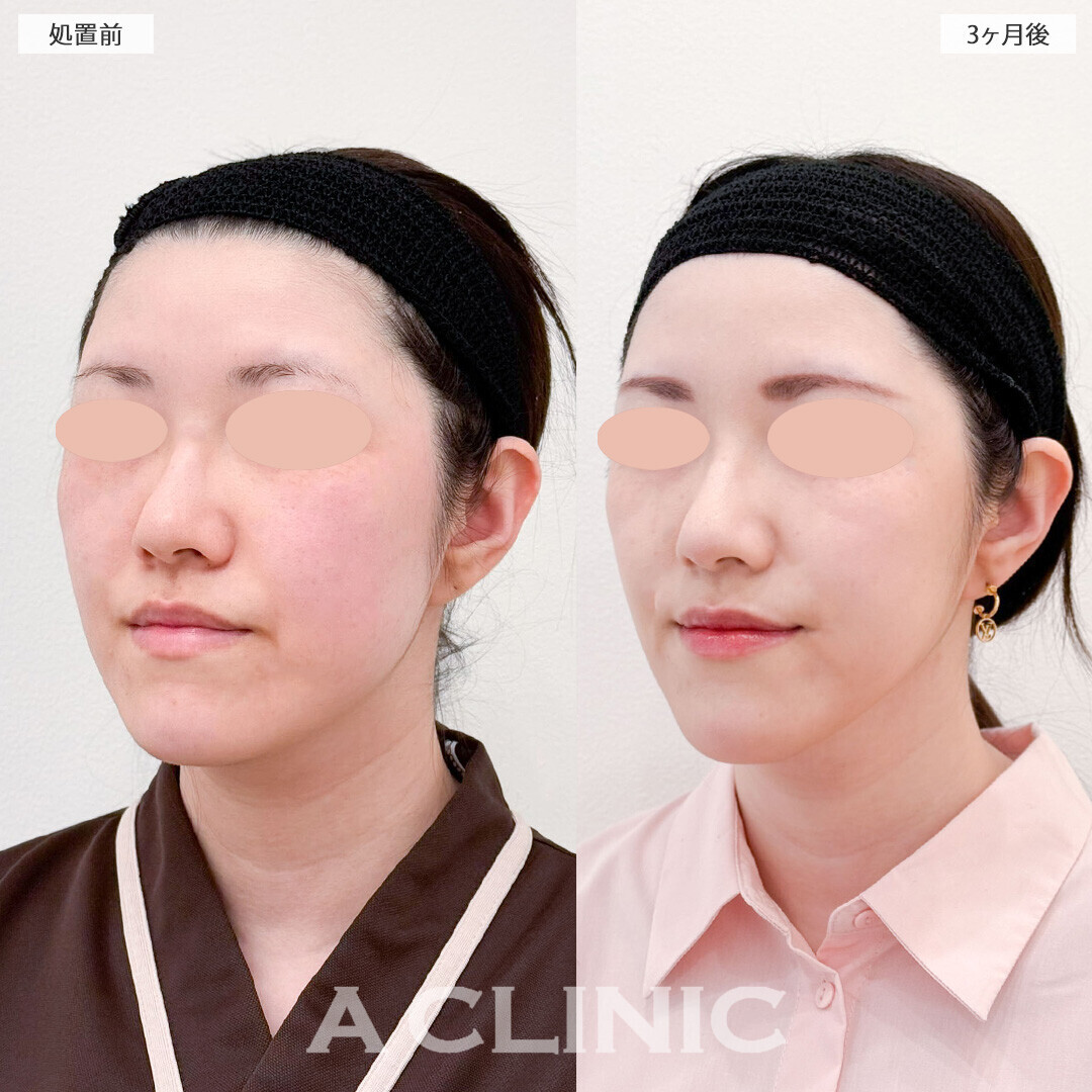 1day小顔脂肪吸引と小顔エラボトックスで更にスッキリした小顔に！処置前と3ヶ月後の症例です(30代女性)