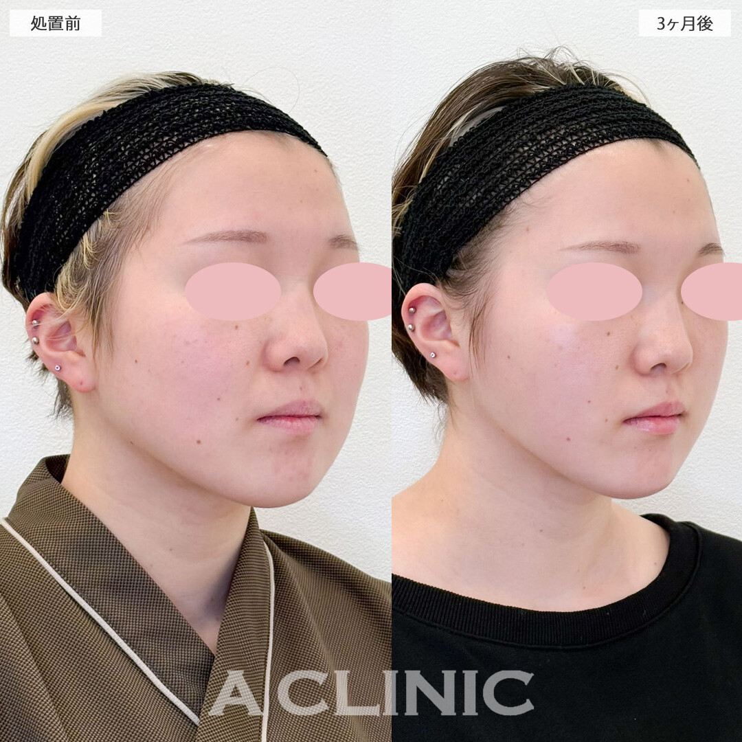 1day小顔脂肪吸引と小顔エラボトックスで丸顔とほうれい線の悩みを解消！こちら処置前と3ヶ月後の症例です(20代女性)