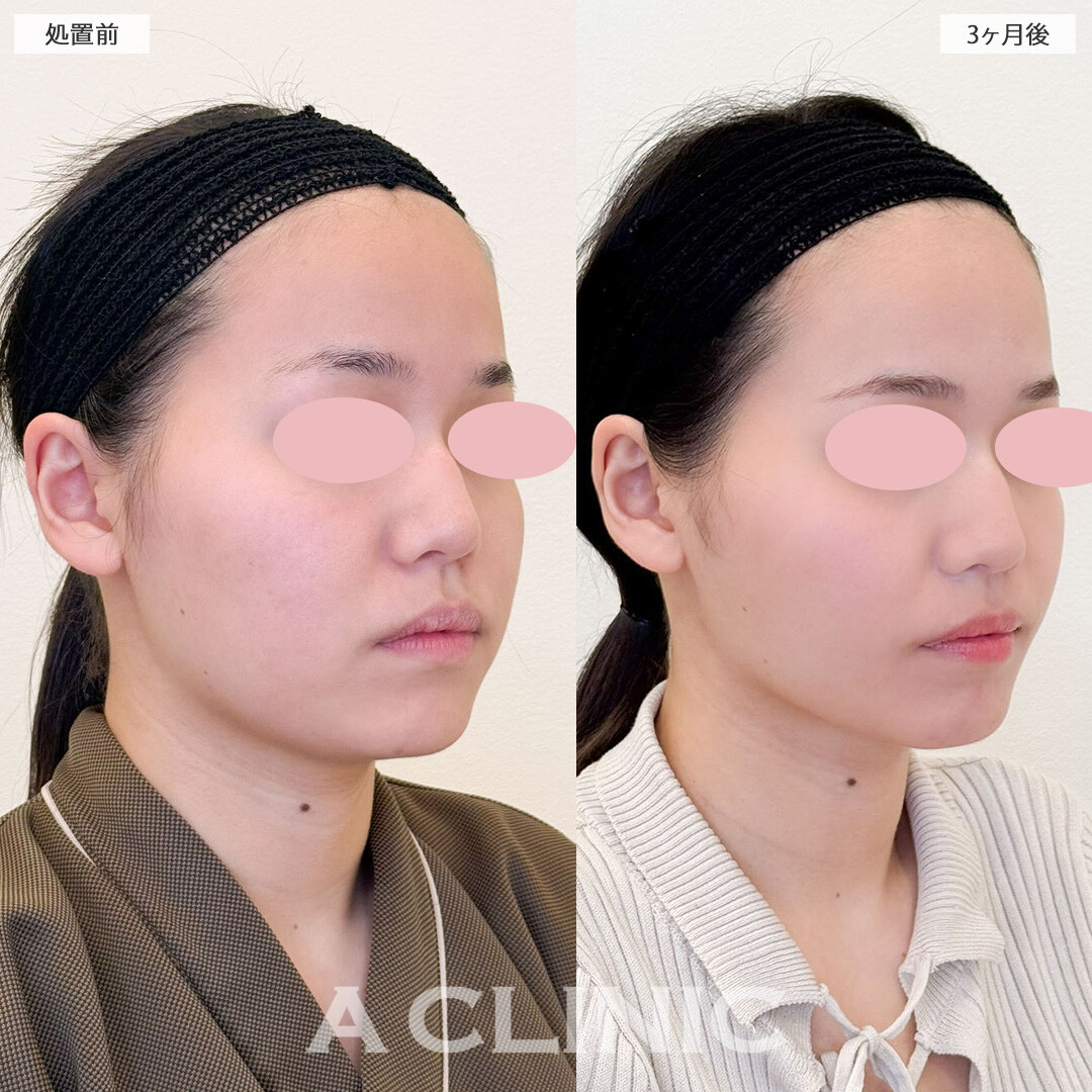 1day小顔脂肪吸引と小顔エラボトックスでお顔が一回り小さく！こちら処置前と処置3ヶ月後の症例です(20代女性)