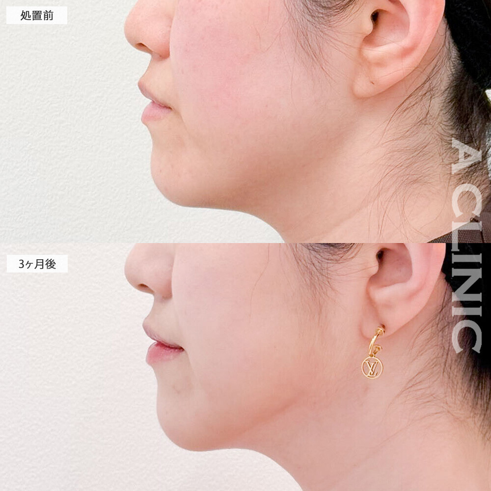 1day小顔脂肪吸引と小顔エラボトックスで更にスッキリした小顔に！処置前と3ヶ月後の症例です(30代女性)