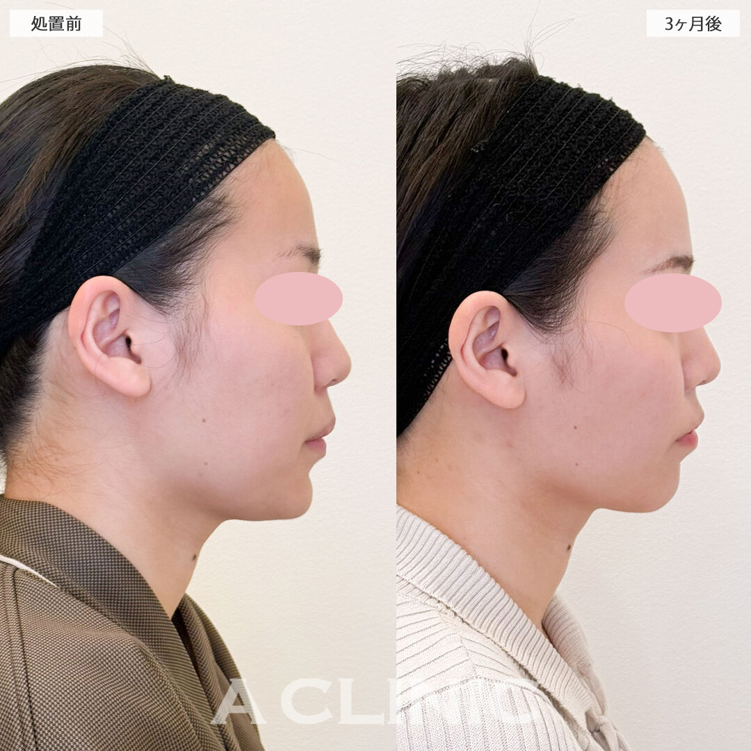 1day小顔脂肪吸引と小顔エラボトックスでお顔が一回り小さく！こちら処置前と処置3ヶ月後の症例です(20代女性)
