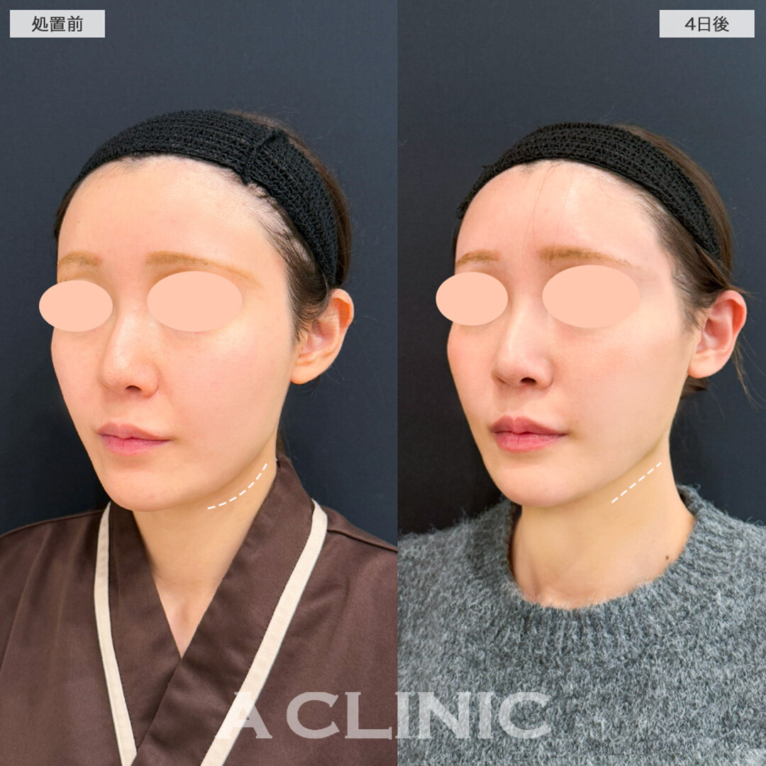 1day小顔脂肪吸引とヒアルロン酸注射(シワ)を受けてから4日後でも腫れ最小限です！こちら処置前と4日後の症例です。(30代女性)