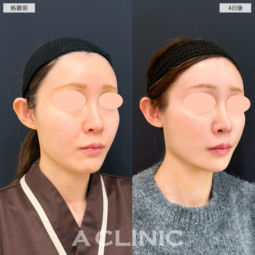 1day小顔脂肪吸引とヒアルロン酸注射(シワ)を受けてから4日後でも腫れ最小限です！こちら処置前と4日後の症例です。(30代女性)
