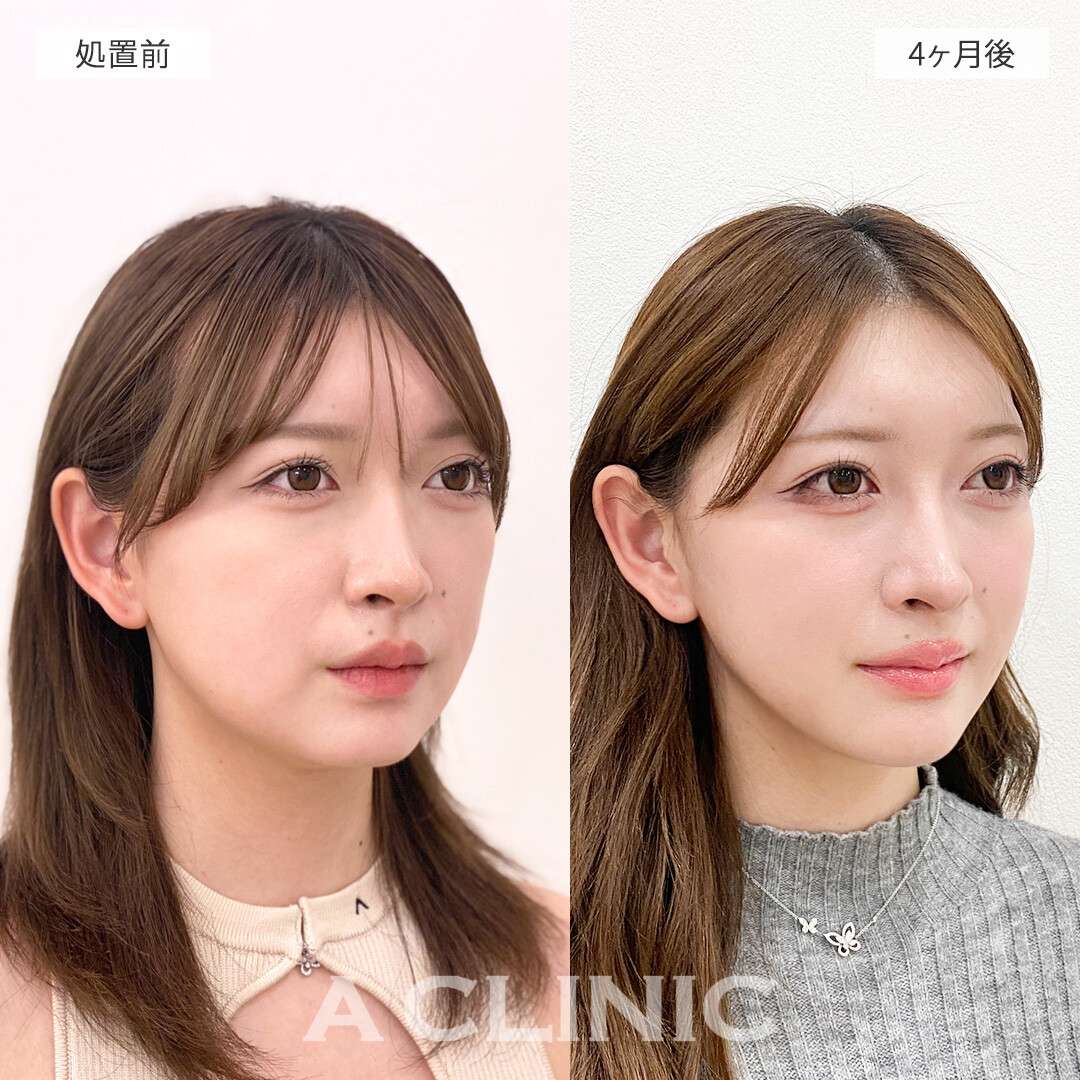 1day小顔脂肪吸引で小顔になってフェイスラインもクッキリ！処置前と4ヶ月後の症例です(10代女性)