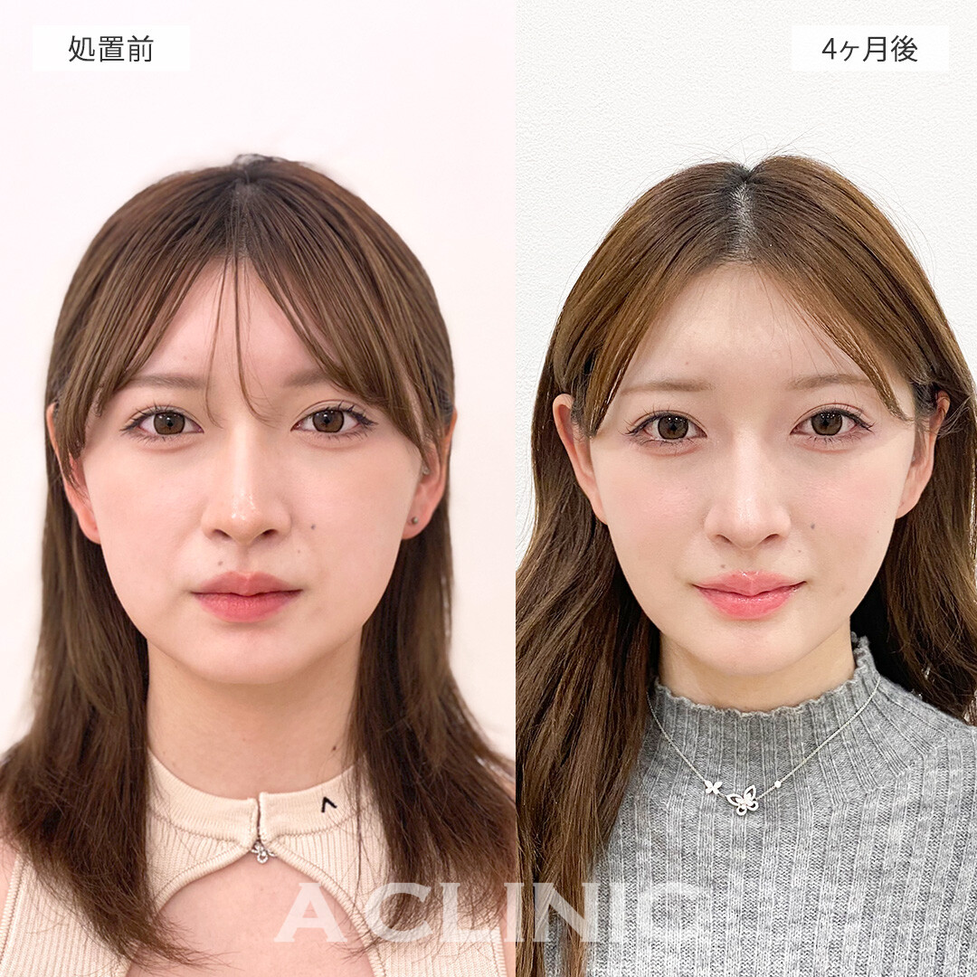 1day小顔脂肪吸引で小顔になってフェイスラインもクッキリ！処置前と4ヶ月後の症例です(10代女性)