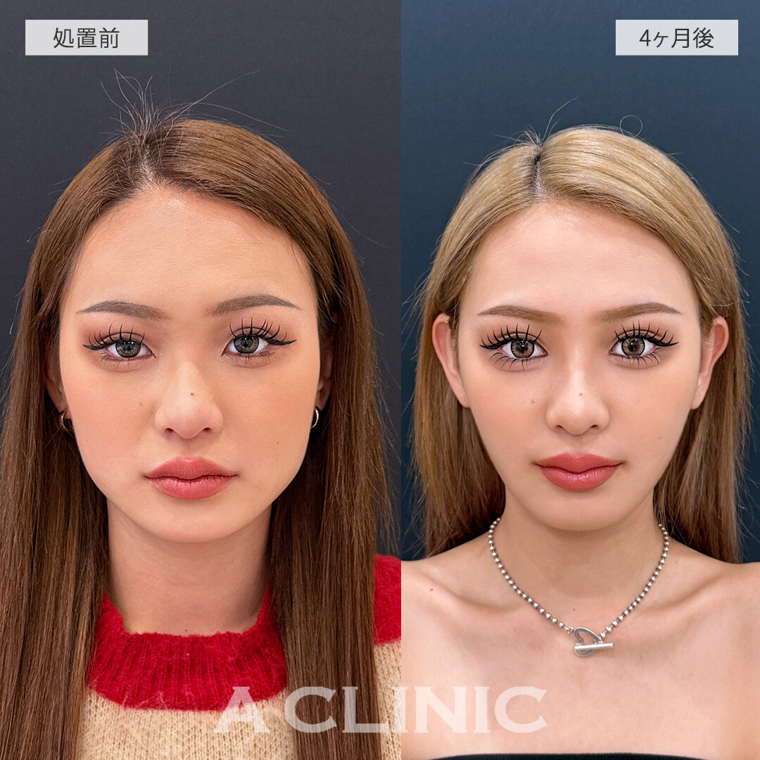 脂肪吸引で別人級の小顔に大変身！こちら1day小顔脂肪吸引の処置前と4ヶ月後の症例です(20代女性)