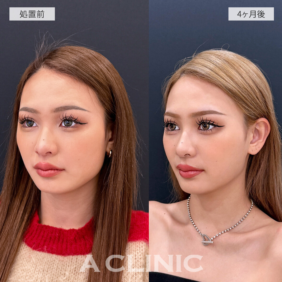 脂肪吸引で別人級の小顔に大変身！こちら1day小顔脂肪吸引の処置前と4ヶ月後の症例です(20代女性)