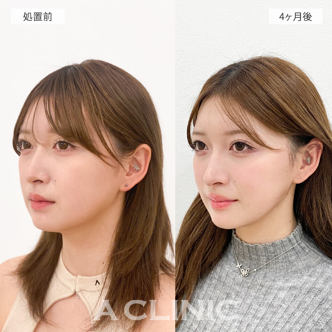 1day小顔脂肪吸引で小顔になってフェイスラインもクッキリ！処置前と4ヶ月後の症例です(10代女性)