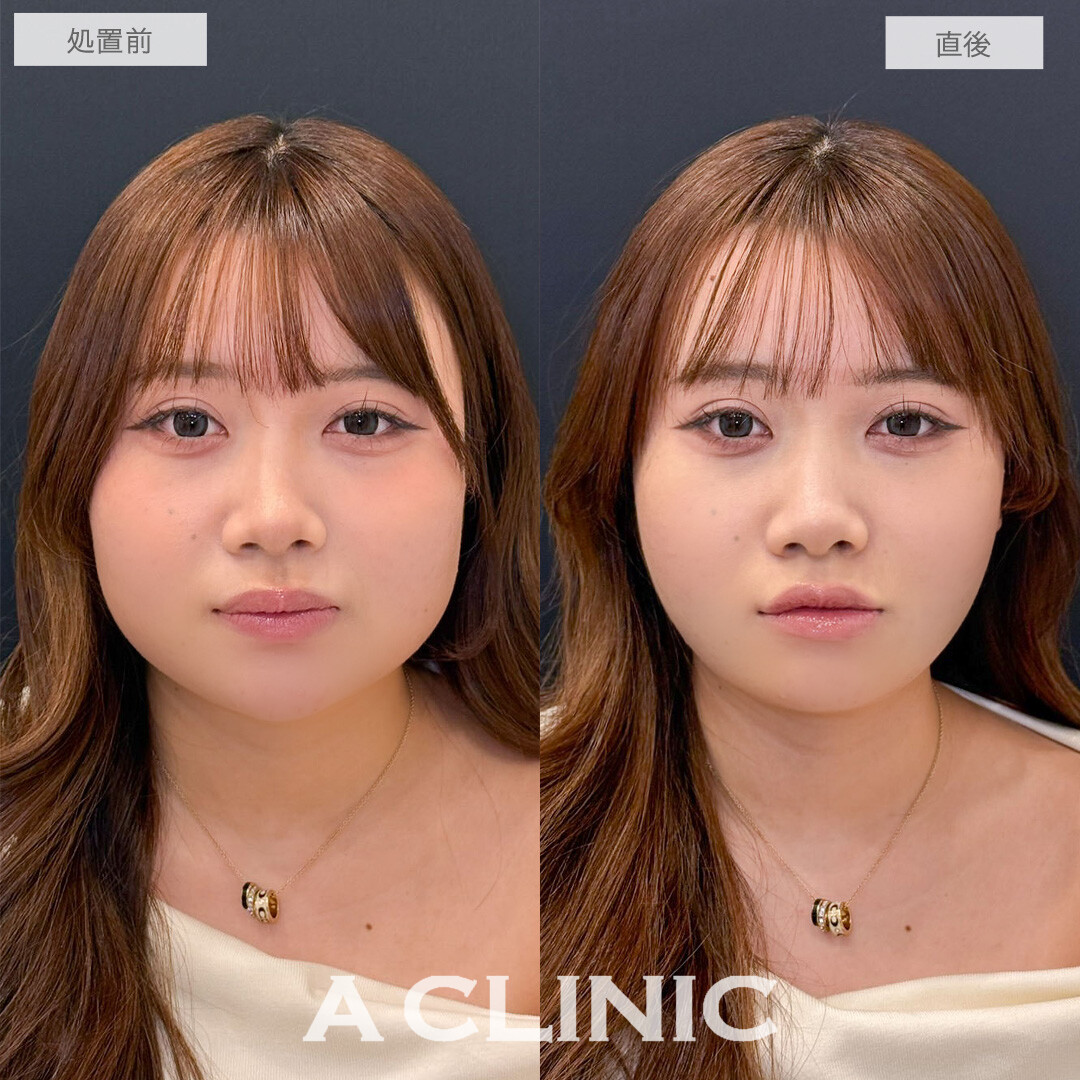 1day小顔脂肪吸引で直後からお悩みだった口横のポニョ改善しました！こちら処置前と直後の症例です(20代女性)
