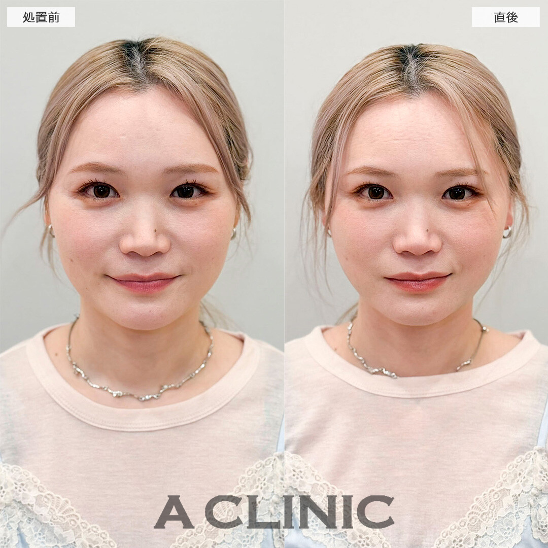 1day小顔脂肪吸引で直後から今までの輪郭との変化を実感！処置前と直後の症例です(30代女性)