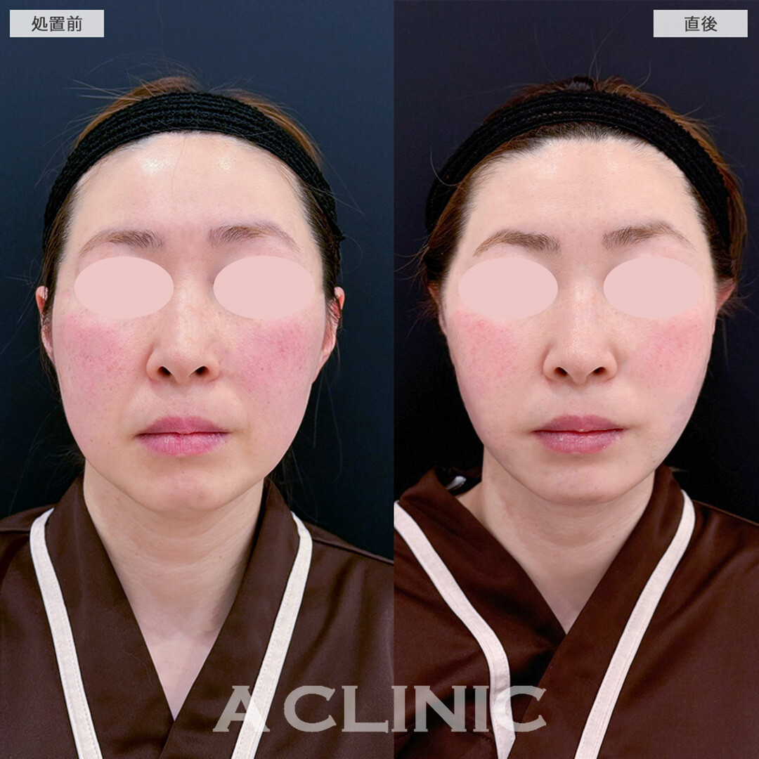 1day小顔脂肪吸引で痩せにくい顔周りや顎下のお悩みを即日解決！こちら処置前と直後の症例です(30代女性)