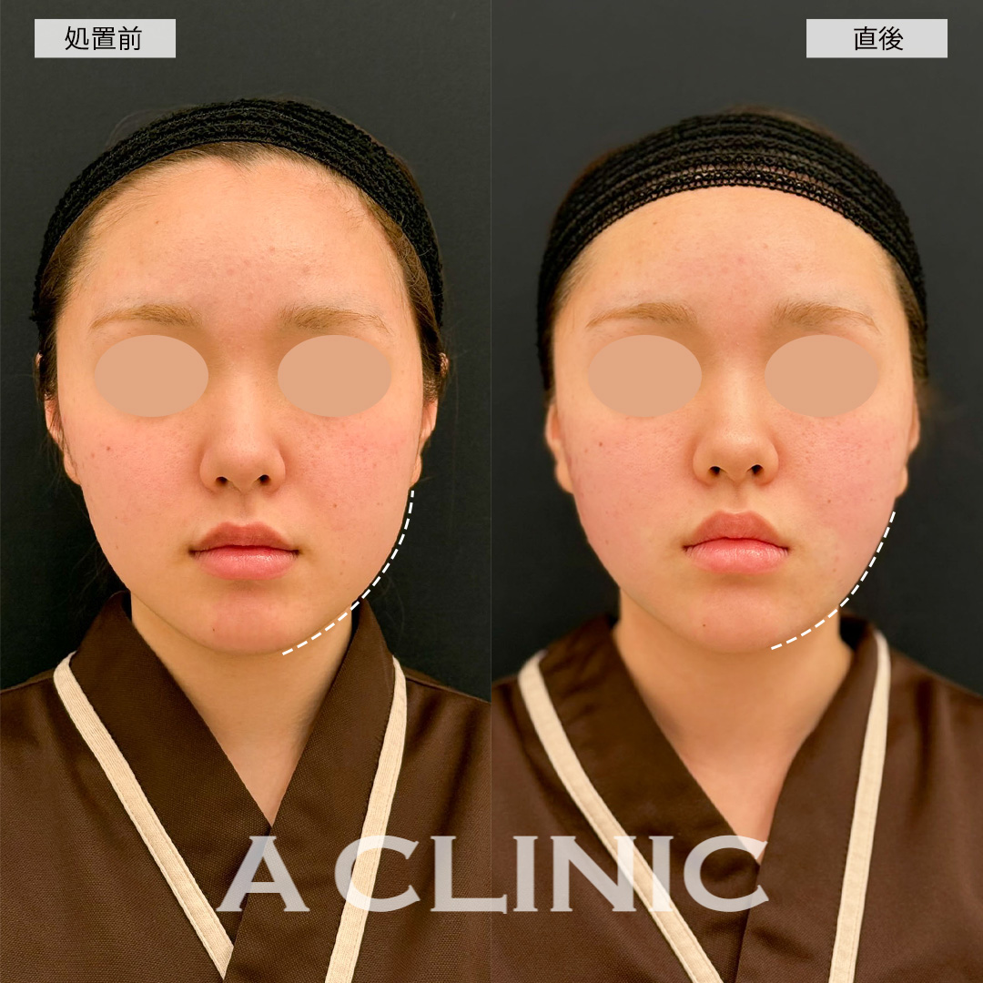 1day小顔脂肪吸引で輪郭すっきり叶います！こちら処置前と直後の症例です(10代女性)