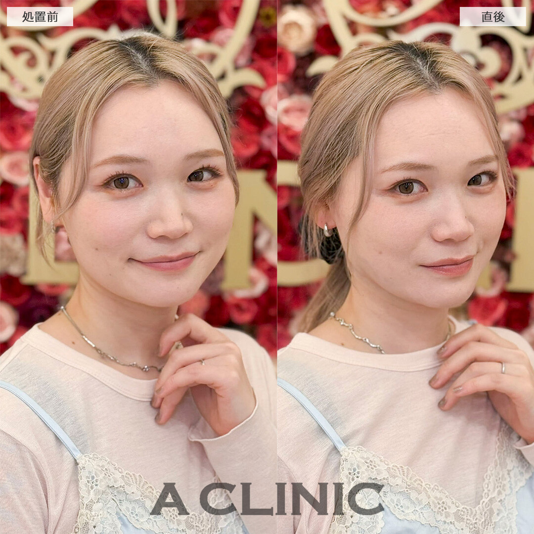 1day小顔脂肪吸引で直後から今までの輪郭との変化を実感！処置前と直後の症例です(30代女性)