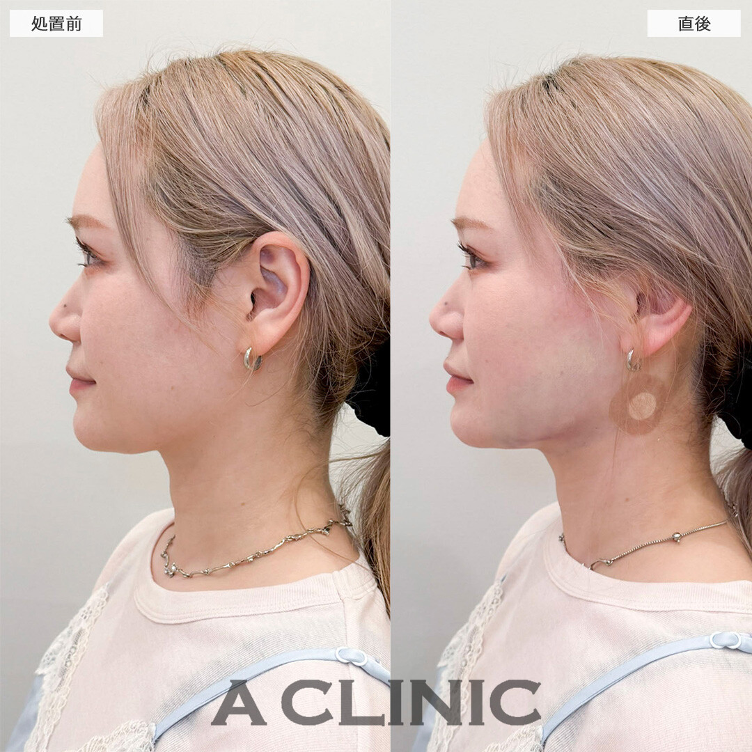 1day小顔脂肪吸引で直後から今までの輪郭との変化を実感！処置前と直後の症例です(30代女性)