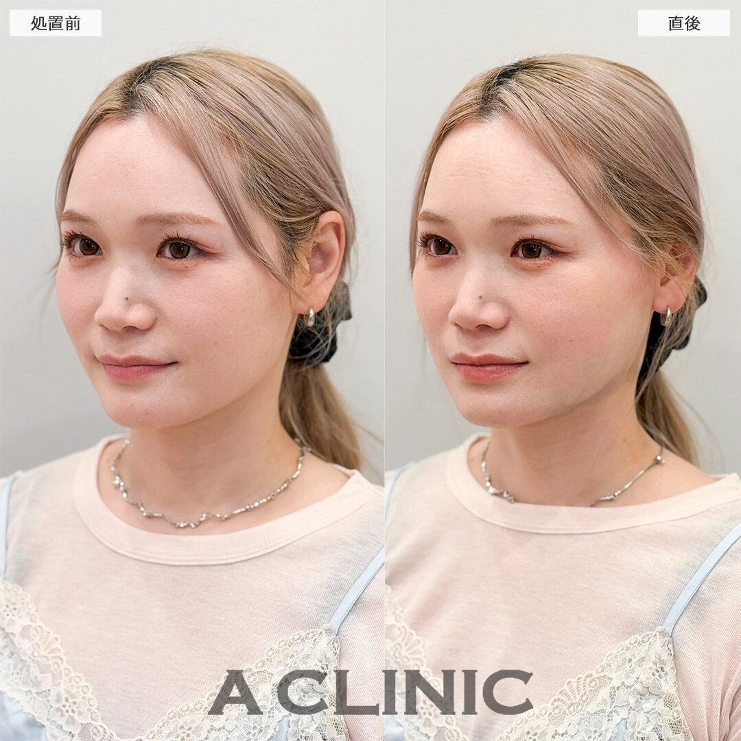 1day小顔脂肪吸引で直後から今までの輪郭との変化を実感！処置前と直後の症例です(30代女性)