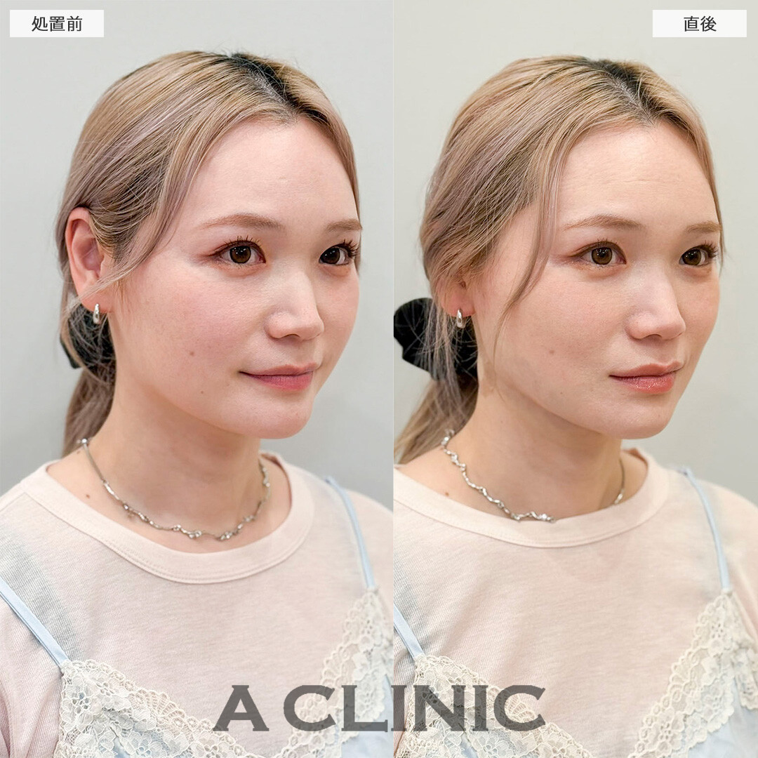 1day小顔脂肪吸引で直後から今までの輪郭との変化を実感！処置前と直後の症例です(30代女性)