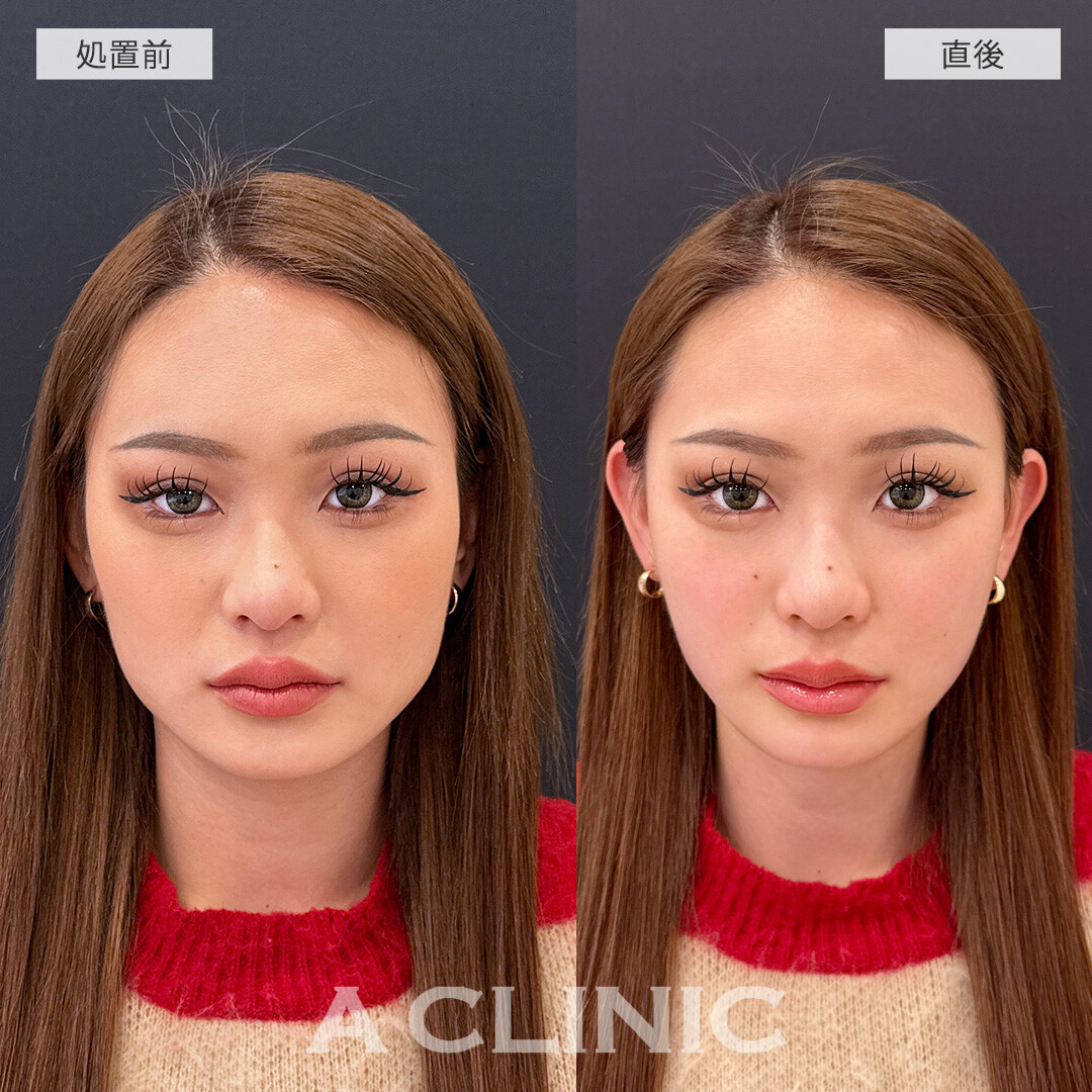 1day小顔脂肪吸引なら施術直後から腫れ最小限で小顔になれます！こちら処置前と直後の症例です(20代女性)