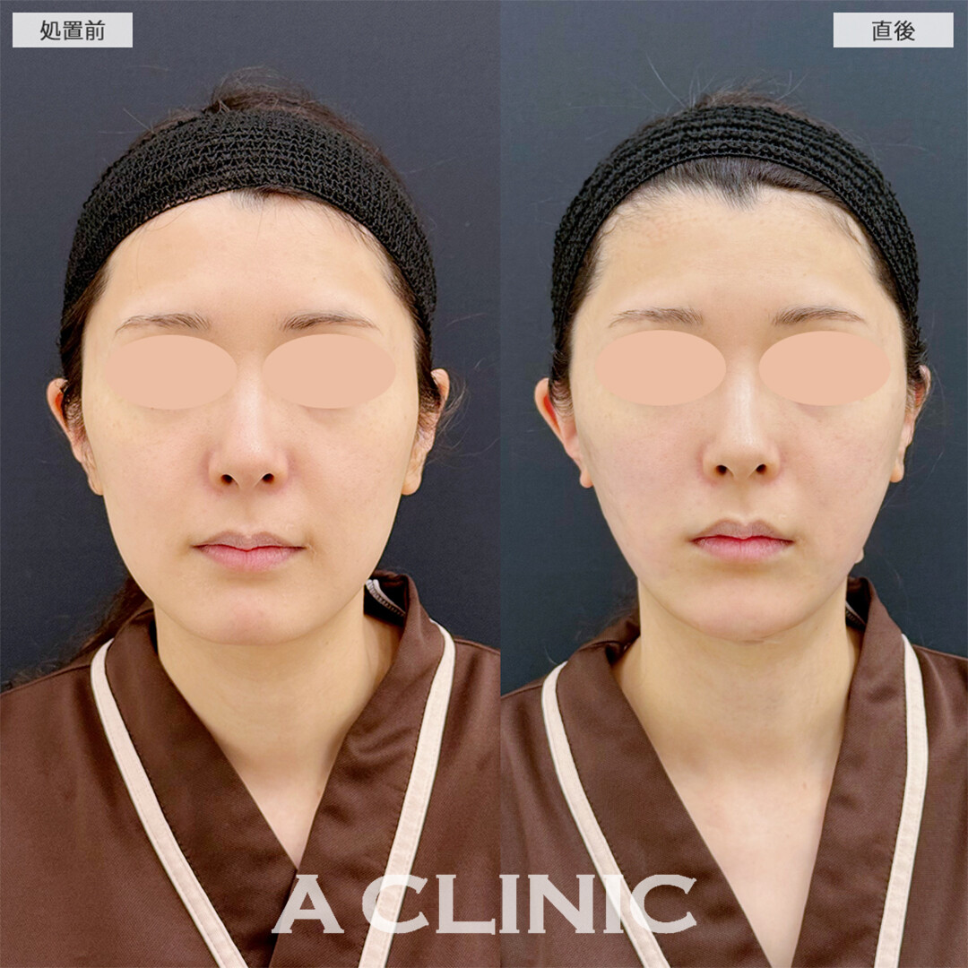 1day小顔脂肪吸引とあごへのヒアルロン酸注入は直後からVフェイスになれます！こちら処置前と直後の症例です(20代女性)