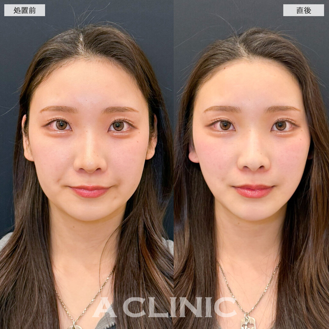 1day小顔で施術直後から写真が映える輪郭に！こちら処置前と処置直後の症例です(20代女性)