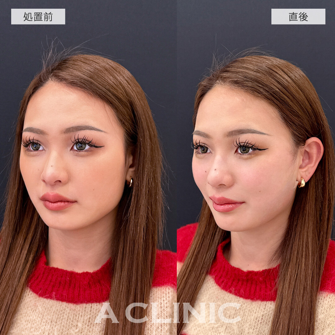 1day小顔脂肪吸引なら施術直後から腫れ最小限で小顔になれます！こちら処置前と直後の症例です(20代女性)