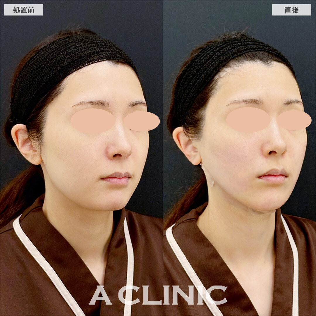 1day小顔脂肪吸引とあごへのヒアルロン酸注入は直後からVフェイスになれます！こちら処置前と直後の症例です(20代女性)